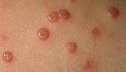 楊浩康(Yeung Ho Hong)醫生講解傳染性軟疣