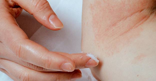 楊浩康(Yeung Ho Hong)醫生講解治療濕疹的外用藥膏