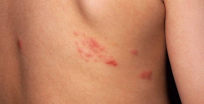 楊浩康(Yeung Ho Hong)醫生講解生蛇