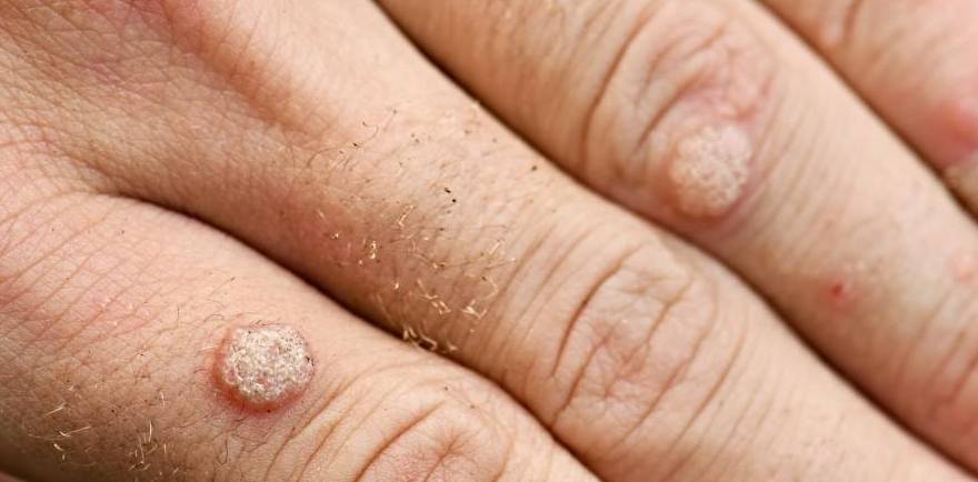 楊浩康(Yeung Ho Hong)醫生講解甚麼是疣?