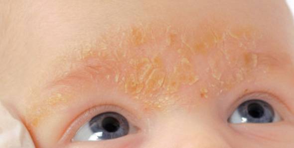 楊浩康(Yeung Ho Hong)醫生講解甚麼是脂漏性皮膚炎