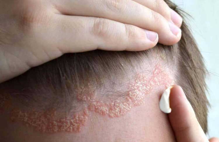 楊浩康(Yeung Ho Hong)醫生講解如何治療脂漏性皮膚炎